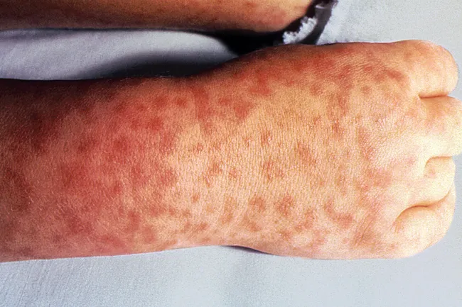 Pictures Of Viral Rashes In Adults Children