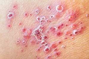 shingles rash close up