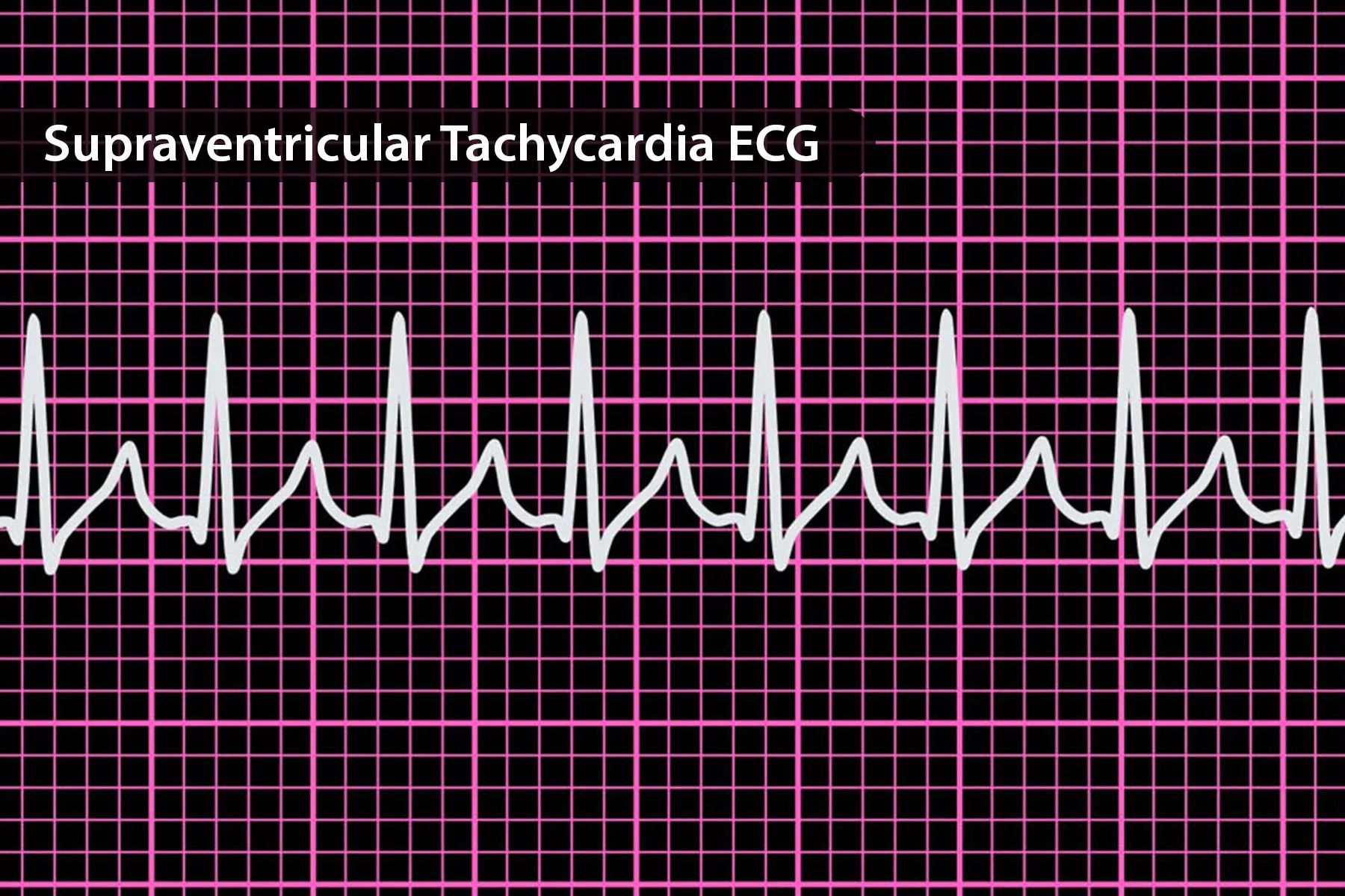 photo of tachycardia ecg