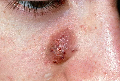 Cyst acne