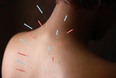 corbis rf photo of acupuncture needles in womans back