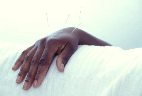 corbis rm photo of hand with acupuncture needle - آشنایی کامل با طب سوزنی