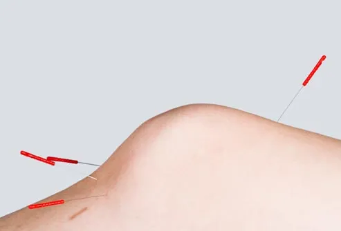 getty rm photo of acupuncture in knee - آشنایی کامل با طب سوزنی