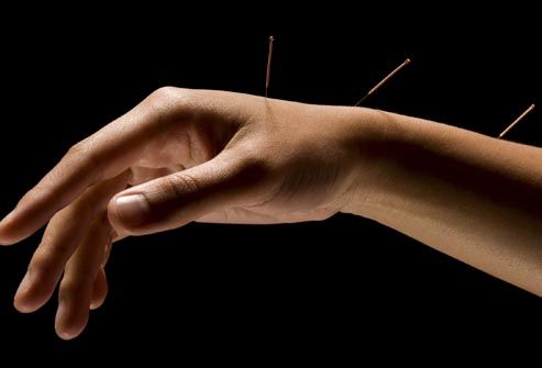 arm acupuncture