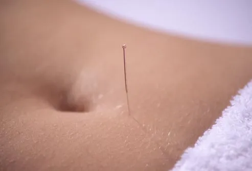 stomach acupuncture