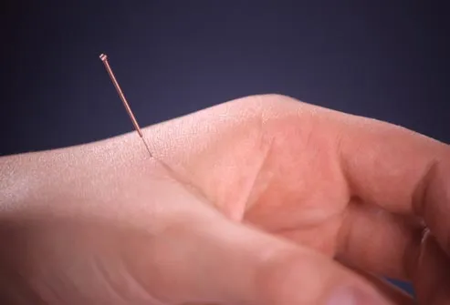 photolibrary rm photo of needle in hand. - آشنایی کامل با طب سوزنی