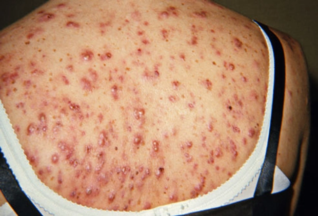 What is deep-cyst acne?