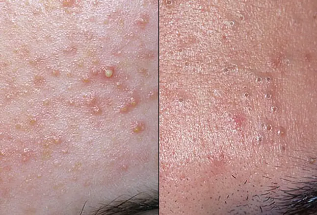 Photo of acne whiteheads and blackheads