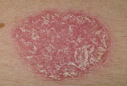 Dry patch of skin