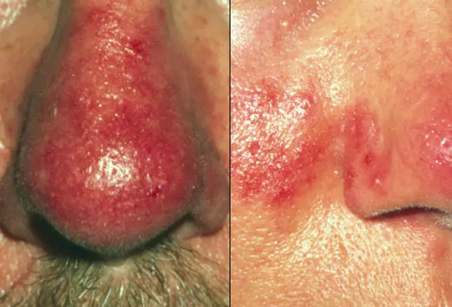 Photo composite of rosacea symptoms
