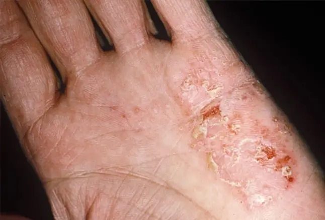 Photo of eczema on a hand