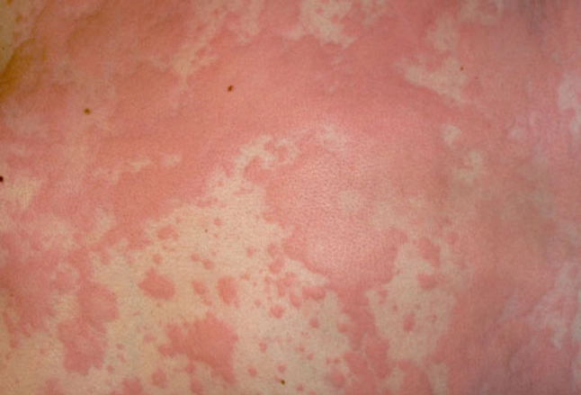 Picture of Hives (urticaria)