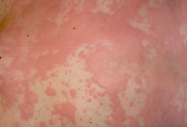 Photo of Hives (Urticaria) Skin Rash