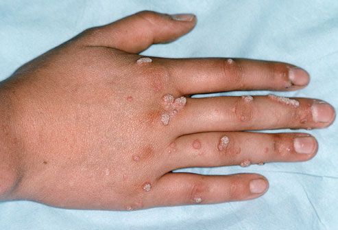 warts hands rash)
