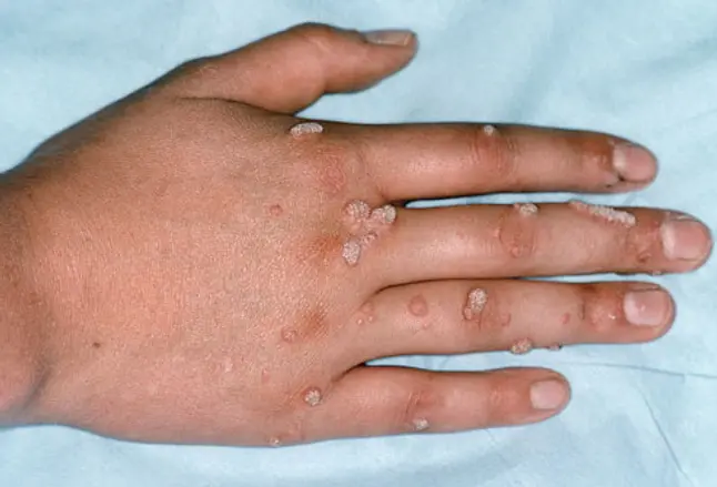Photo of warts on hand and fingers