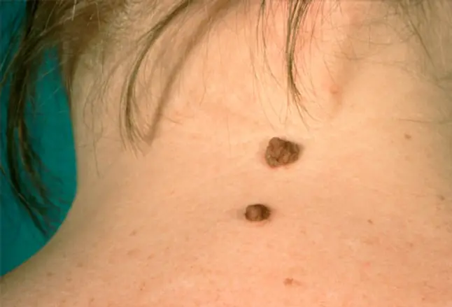 Photo of a mole on the back of a woman's neck