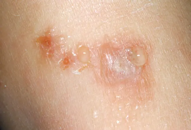 Photo of poison ivy skin rash