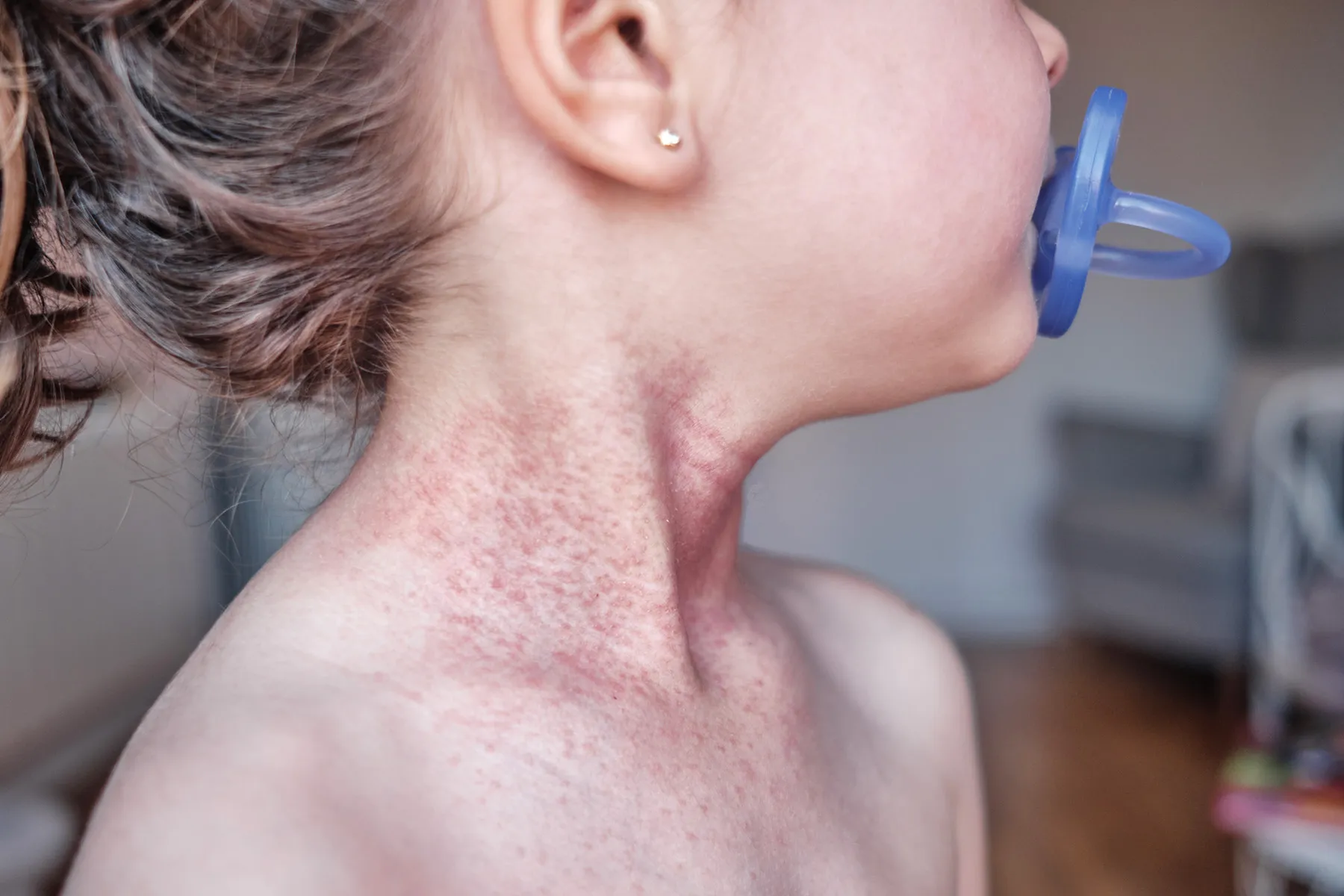 photo of eczema on girl