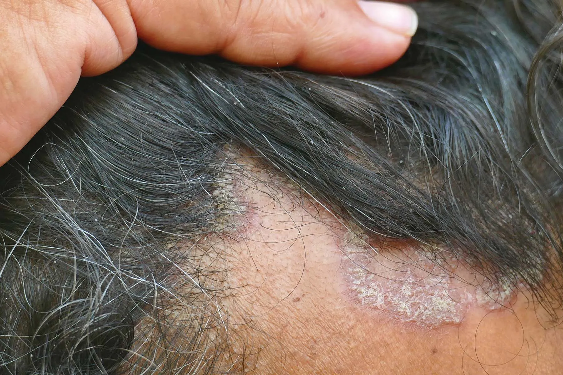 photo of scalp eczema