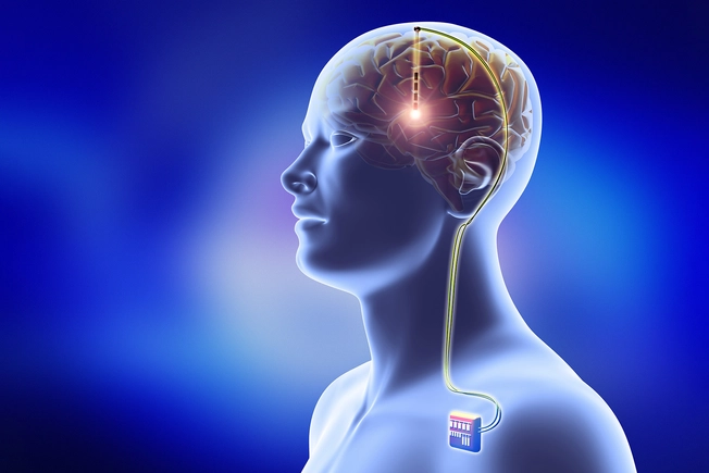 Deep Brain Stimulation (DBS)