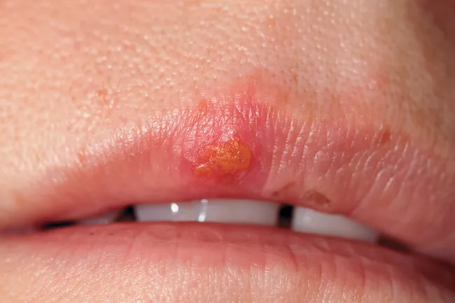 photo of cold sores