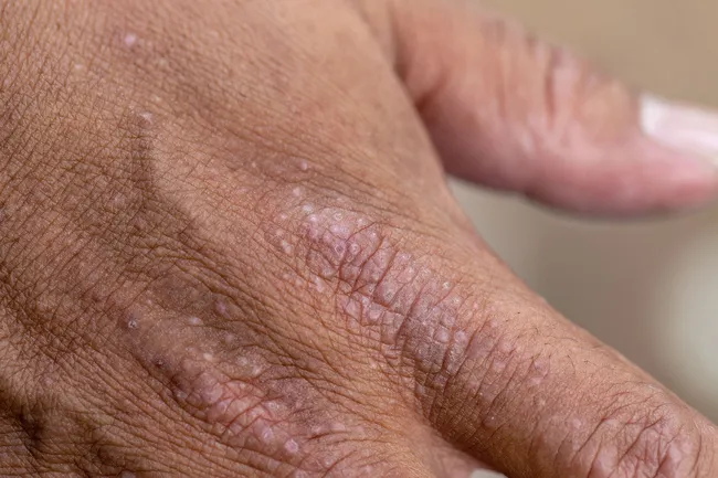 photo of dermatitis on hand