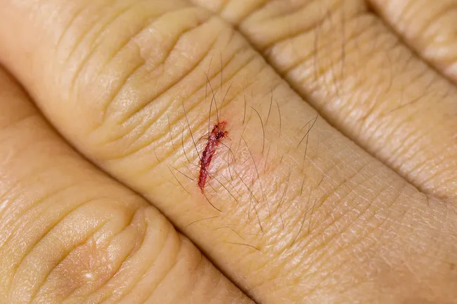 photo of cut on hand