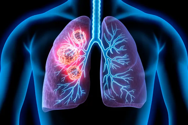 photo illustration of lung cancer