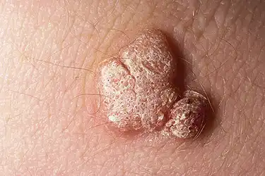 hpv warts side effects