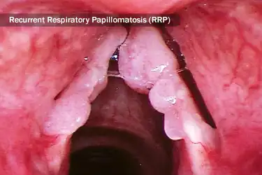 hpv in genital area inverted papilloma removal
