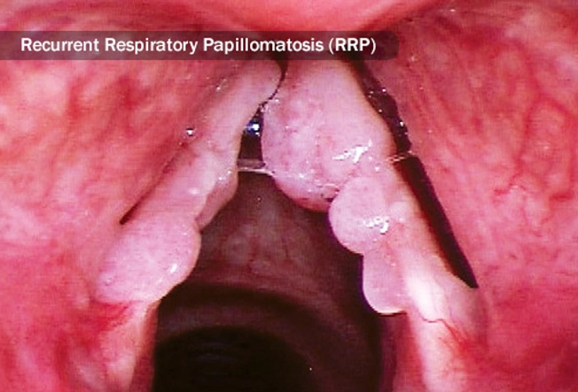 Respiratory Tract Tumors