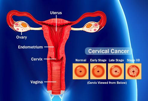 genital hpv and cancer)