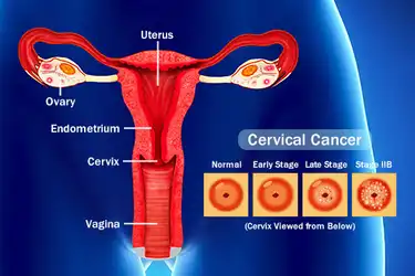Szemölcsök a vulva kezelésén, A női nemi szervek daganatai