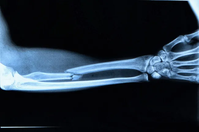 photo of broken arm xray