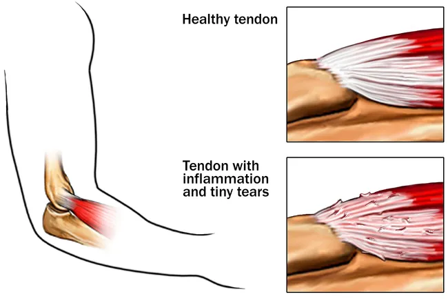 illustration of tendon