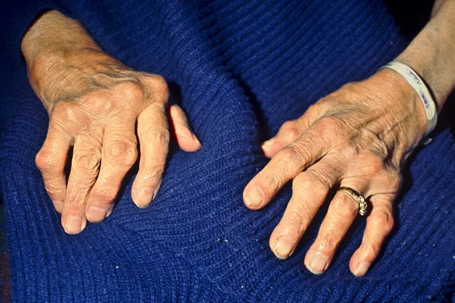 photo of hands with osteoporosis