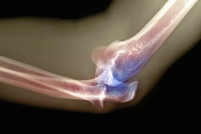 photo of dislocated elbow