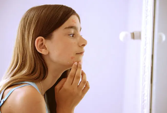 Acne: An Early Sign of Puberty