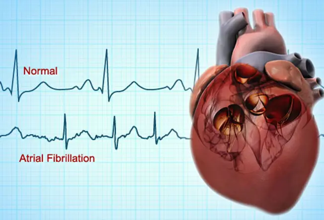 What Is AFib?