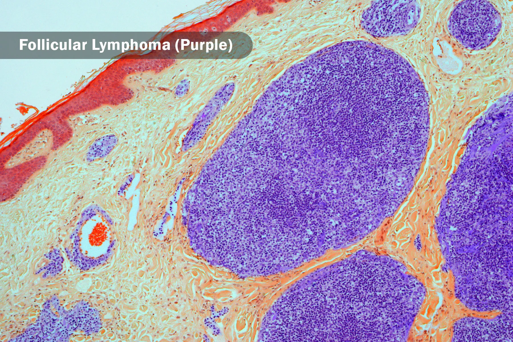 B-cell lymphoma light micrograph