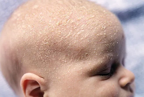 white scalp on baby head