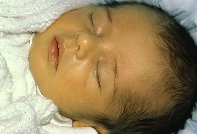 The face of a 3-week-old baby with jaundice