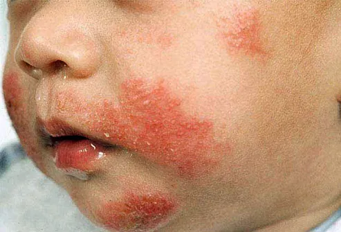 eczema on infants face