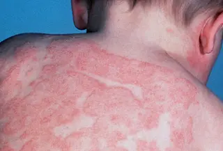 Atopic dermatitis (eczema) on an infant's back