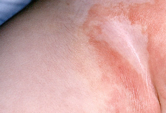 Image result for diaper rash