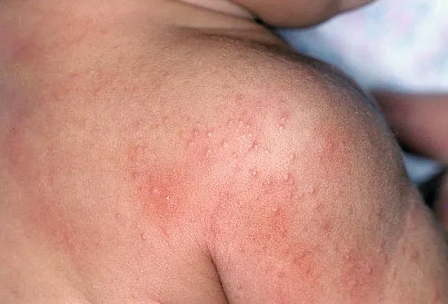 Heat rash on baby's shoulder