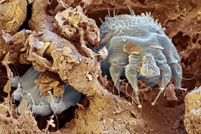 Scabies: Stealthy Pests