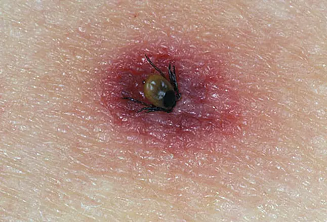Tick burrowing into human skin