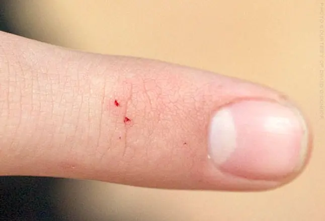 Close-up of black widow spider bite on finger
