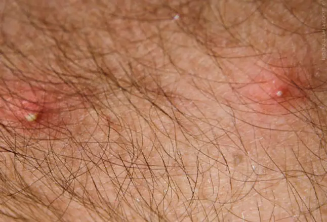 Fire ant bites showing with white pustules